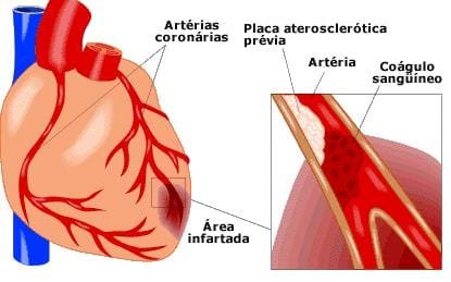 Infarto
